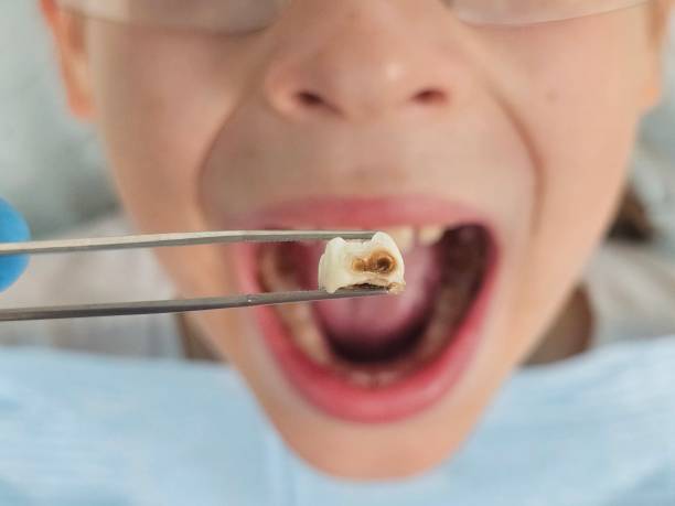Best Emergency Root Canal Treatment in Seat Pleasant, MD